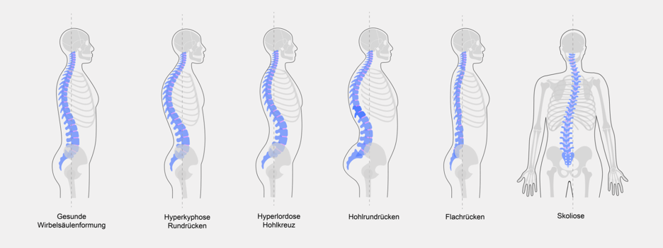 Arten von Fehlhaltungen verursachen Rückenschmerzen